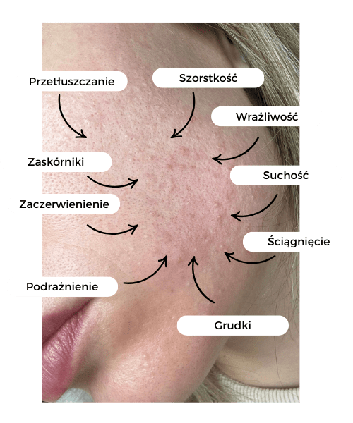 jak odbudować barierę hydrolipidową, uszkodzona bariera hydrolipidowa pielęgnacja domowa, plan pielęgnacji dla zaburzonej bariery hydrolipidowej,