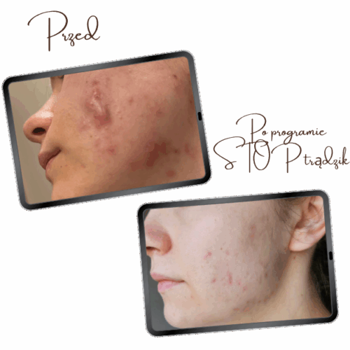 Program Stop trądzik, pielęgnacja cery trądzikowej, pryszcze, konsultacja kosmetologiczna, kosmetolog, kosmetolog online, kosmetolog Wrocław, blizny, przebarwienia, plan pielęgnacji, holistyczne podejście do trądziku,